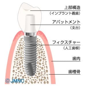 第二の永久歯と呼ばれる、インプラント