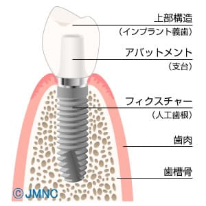 インプラントの構造