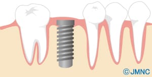 インプラントの1回目の手術