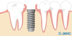 インプラントの2回目の手術