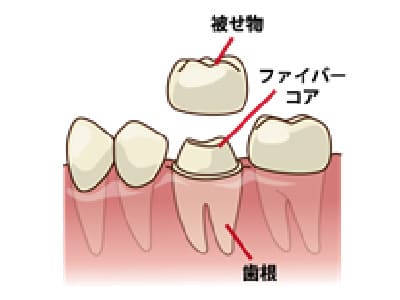 詰め物・かぶせ物の製作