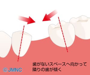 隣の歯が、横に倒れてきてしまいます