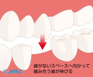 歯がない部分と噛み合う部分