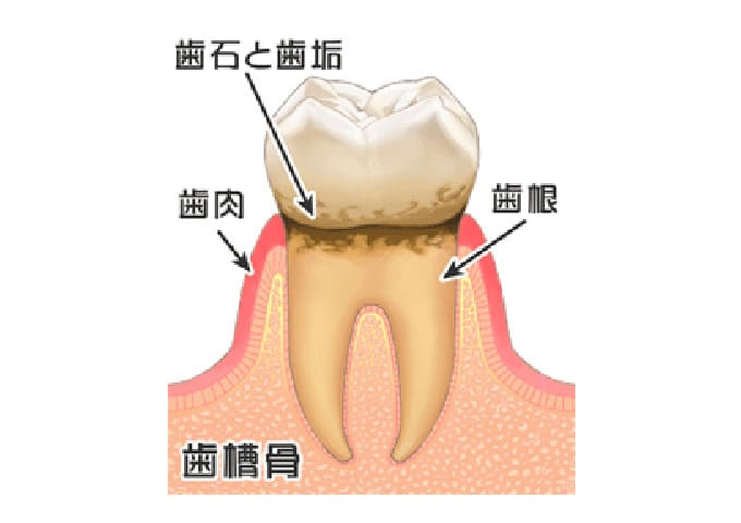 歯肉炎