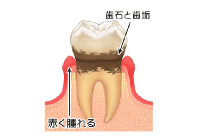 歯周炎