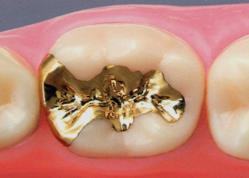 ゴールド（金合金）